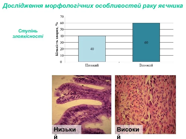 Ступінь злоякісності Дослідження морфологічних особливостей раку яєчника