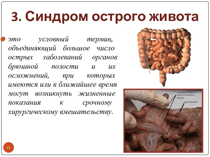 3. Синдром острого живота это условный термин, объединяющий большое число острых заболеваний