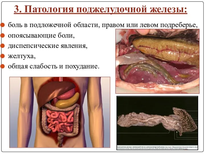 3. Патология поджелудочной железы: боль в подложечной области, правом или левом подреберье,