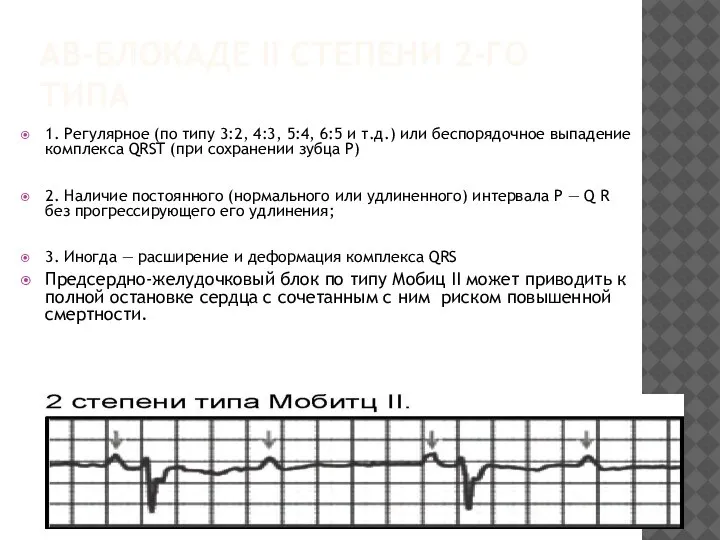 АВ-БЛОКАДЕ II СТЕПЕНИ 2-ГО ТИПА 1. Регулярное (по типу 3:2, 4:3, 5:4,