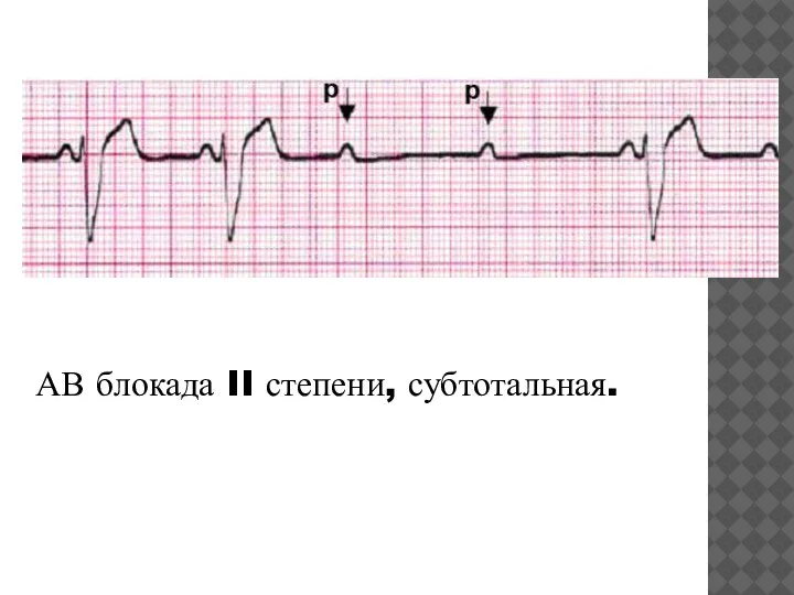 АВ блокада II степени, субтотальная.