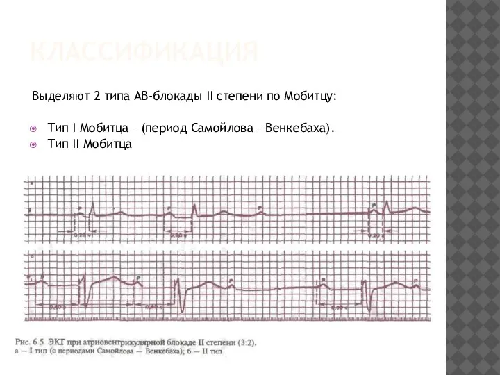 КЛАССИФИКАЦИЯ Выделяют 2 типа АВ-блокады II степени по Мобитцу: Тип I Мобитца