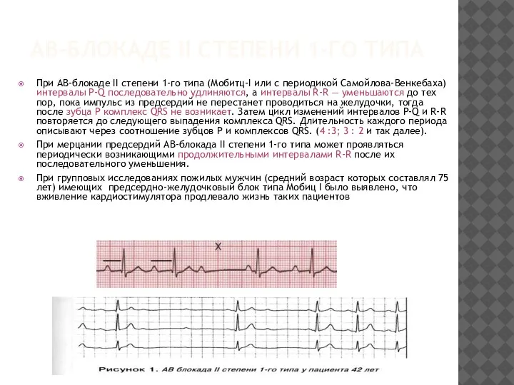 АВ-БЛОКАДЕ II СТЕПЕНИ 1-ГО ТИПА При АВ-блокаде II степени 1-го типа (Мобитц-I