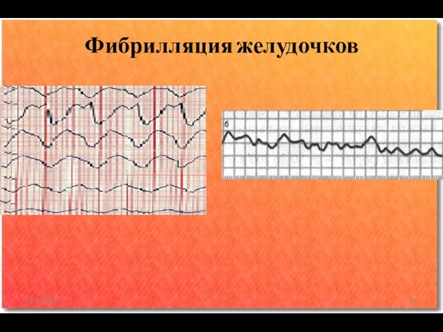 Фибрилляция желудочков 18.02.2016