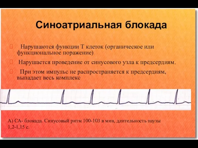 Синоатриальная блокада Нарушаются функции Т клеток (органическое или функциональное поражение) Нарушается проведение