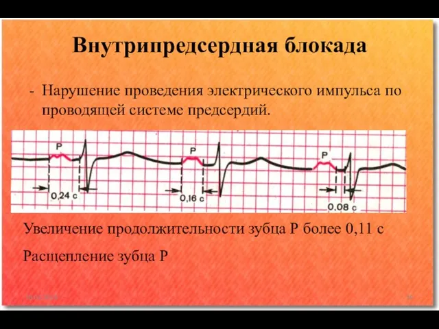 Нарушение проведения электрического импульса по проводящей системе предсердий. Внутрипредсердная блокада 18.02.2016 Увеличение