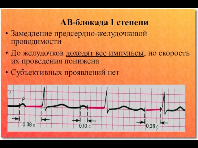 АВ-блокада I степени Замедление предсердно-желудочковой проводимости До желудочков доходят все импульсы, но