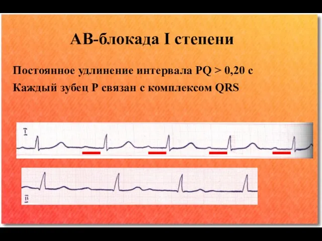 АВ-блокада I степени Постоянное удлинение интервала РQ > 0,20 с Каждый зубец