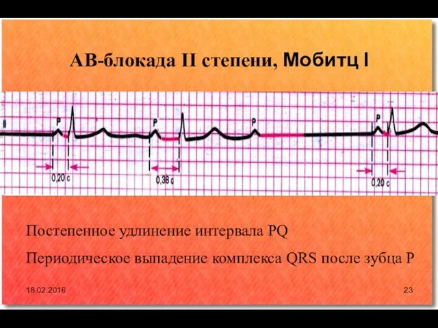 АВ-блокада II степени, Мобитц I Постепенное удлинение интервала PQ Периодическое выпадение комплекса