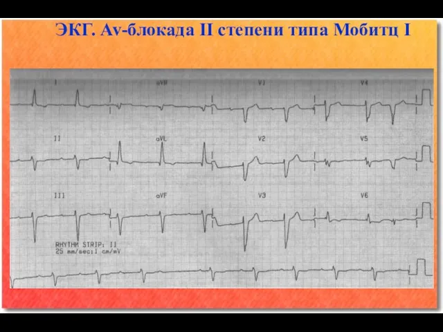 ЭКГ. Av-блокада II степени типа Мобитц I