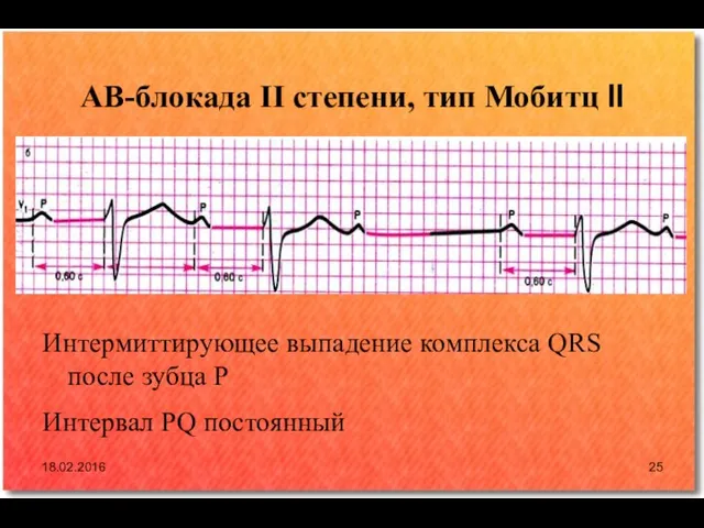 АВ-блокада II степени, тип Мобитц II 18.02.2016 Интермиттирующее выпадение комплекса QRS после