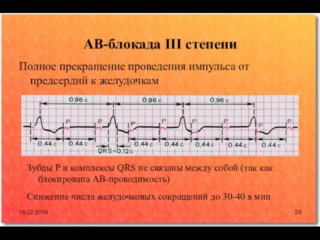 АВ-блокада III степени Полное прекращение проведения импульса от предсердий к желудочкам 18.02.2016