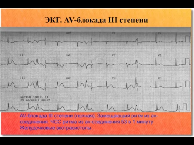 ЭКГ. AV-блокада III степени AV-блокада III степени (полная). Замещающий ритм из av-соединения.