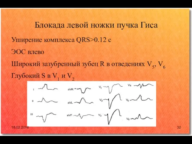 Блокада левой ножки пучка Гиса Уширение комплекса QRS>0.12 с ЭОС влево Широкий