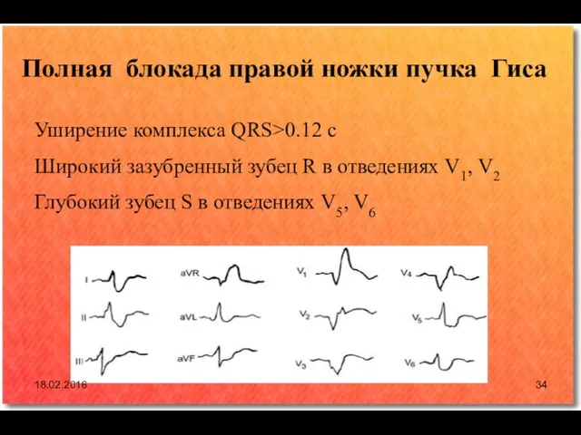 Полная блокада правой ножки пучка Гиса Уширение комплекса QRS>0.12 с Широкий зазубренный