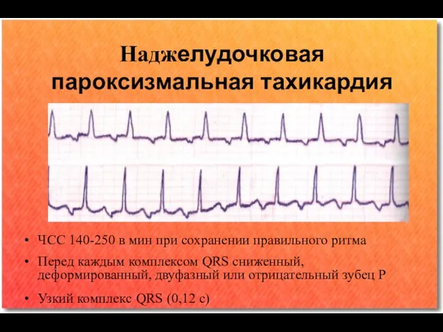 Наджелудочковая пароксизмальная тахикардия ЧСС 140-250 в мин при сохранении правильного ритма Перед