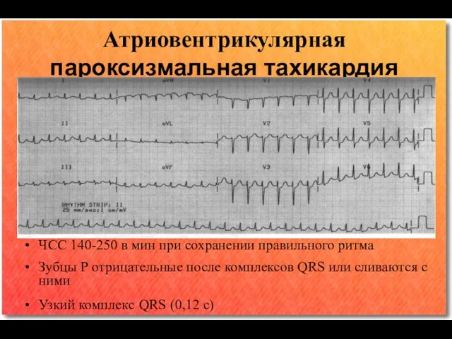 Атриовентрикулярная пароксизмальная тахикардия ЧСС 140-250 в мин при сохранении правильного ритма Зубцы