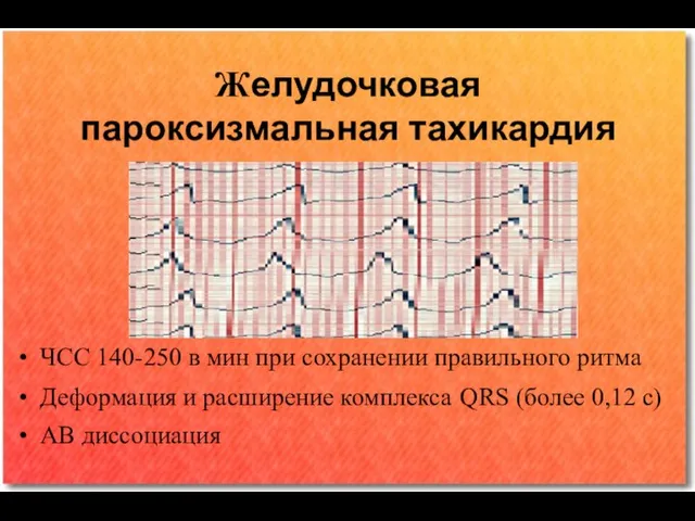 Желудочковая пароксизмальная тахикардия ЧСС 140-250 в мин при сохранении правильного ритма Деформация