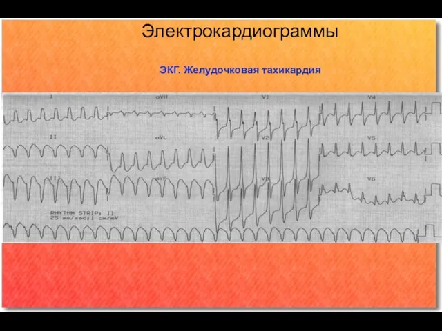 Электрокардиограммы ЭКГ. Желудочковая тахикардия Ритм: тахикардия с расширенными комплексами QRS по форме