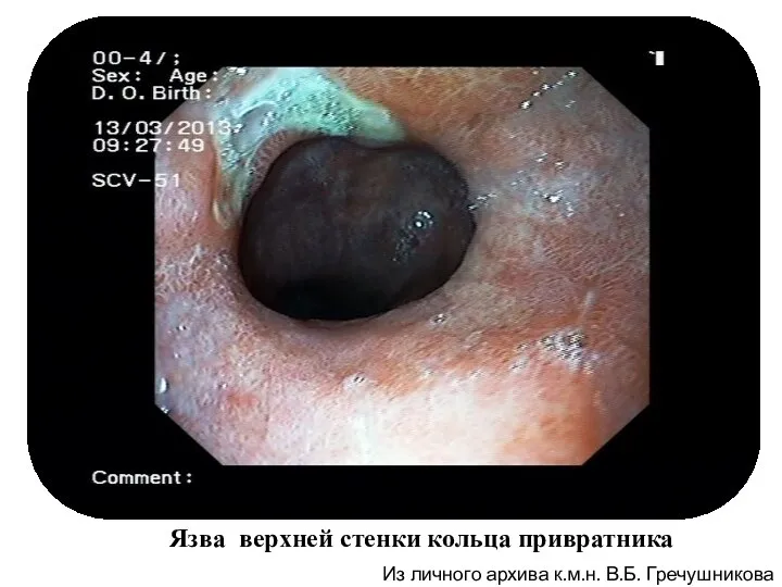Из личного архива к.м.н. В.Б. Гречушникова Язва верхней стенки кольца привратника