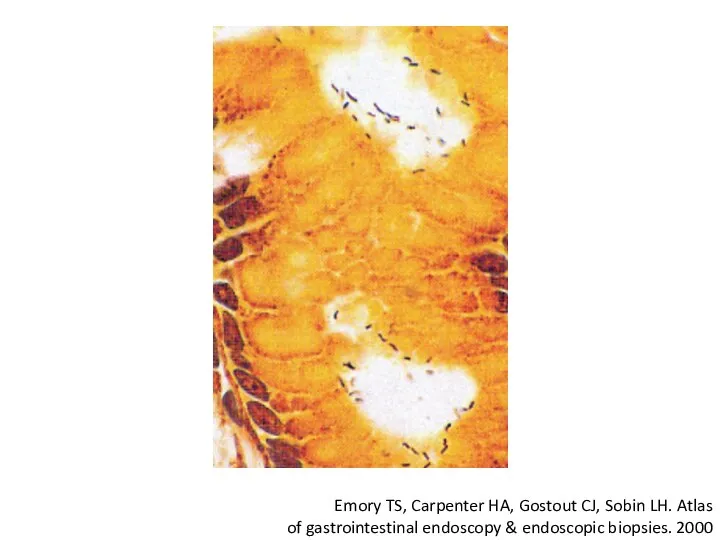 Emory TS, Carpenter HA, Gostout CJ, Sobin LH. Atlas of gastrointestinal endoscopy & endoscopic biopsies. 2000