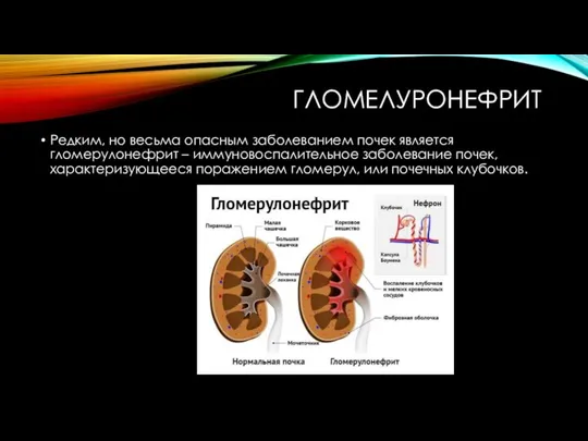 ГЛОМЕЛУРОНЕФРИТ Редким, но весьма опасным заболеванием почек является гломерулонефрит – иммуновоспалительное заболевание