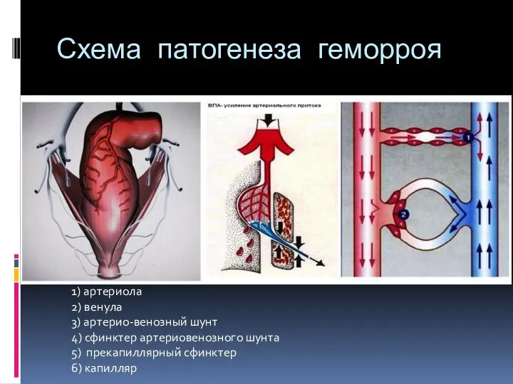 Схема патогенеза геморроя 1) артериола 2) венула 3) артерио-венозный шунт 4) сфинктер