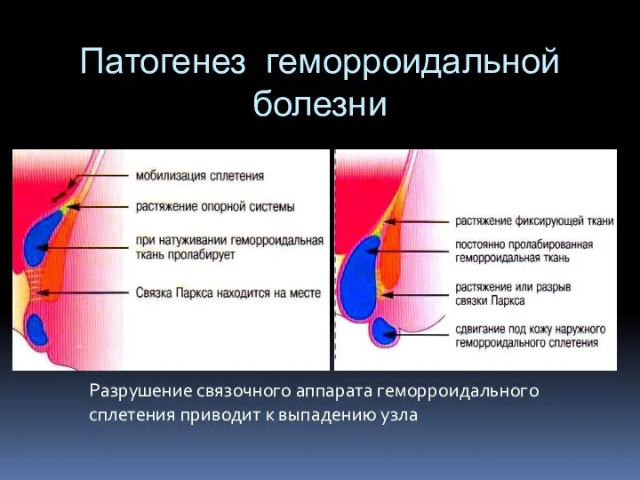 Патогенез геморроидальной болезни Разрушение связочного аппарата геморроидального сплетения приводит к выпадению узла