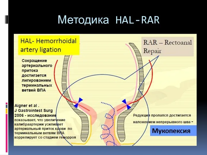 Методика HAL-RAR