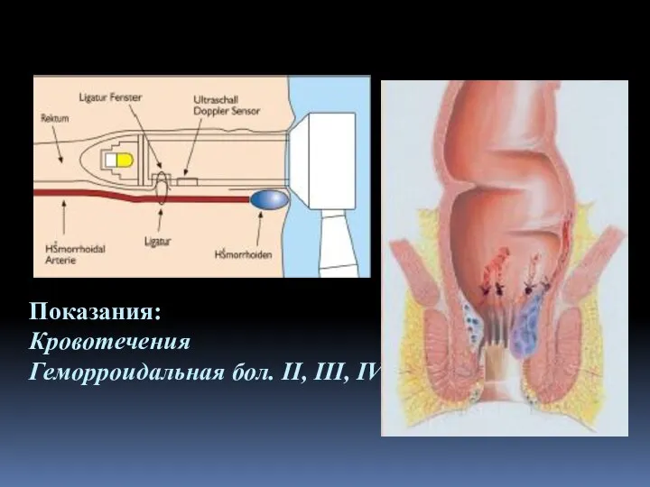 Показания: Кровотечения Геморроидальная бол. II, III, IV