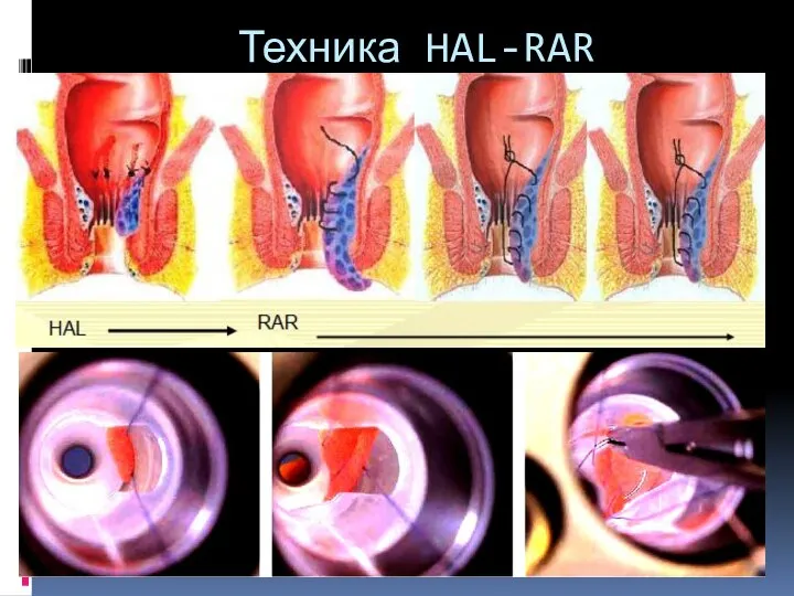 Техника HAL-RAR