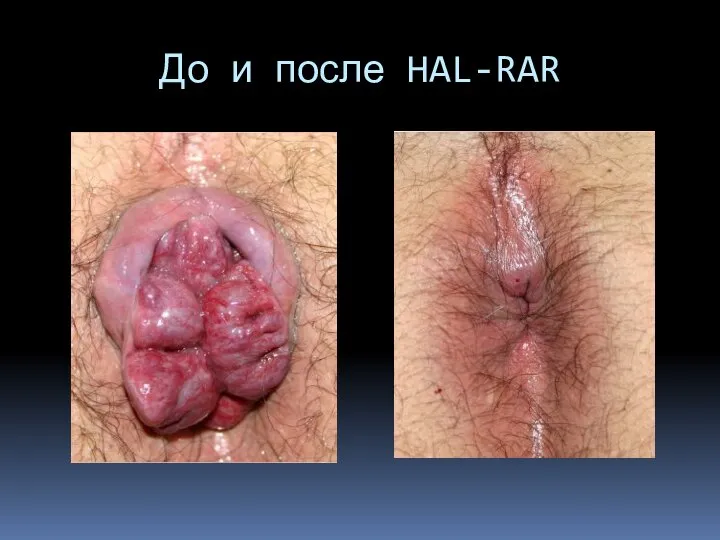 До и после HAL-RAR