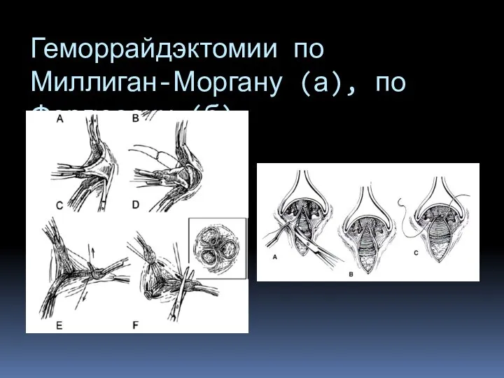 Геморрайдэктомии по Миллиган-Моргану (а), по Фергюсону (б)