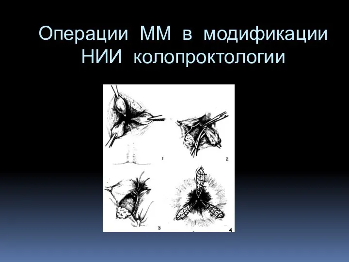 Операции ММ в модификации НИИ колопроктологии