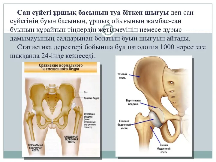 Сан сүйегі ұршық басының туа біткен шығуы деп сан сүйегінің буын басының,