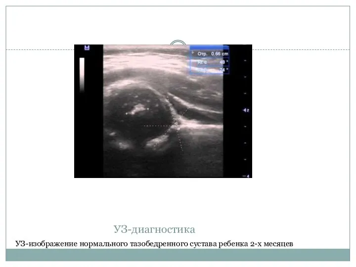 УЗ-диагностика УЗ-изображение нормального тазобедренного сустава ребенка 2-х месяцев