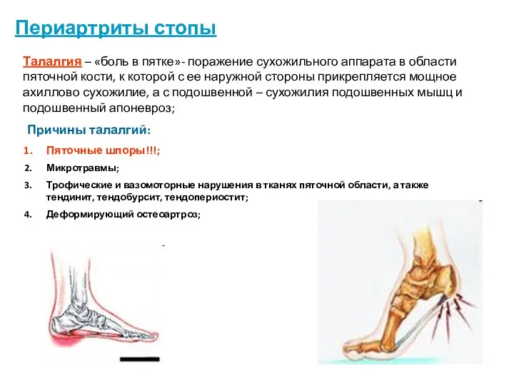 Периартриты стопы Талалгия – «боль в пятке»- поражение сухожильного аппарата в области