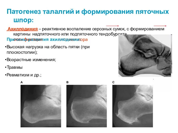 Патогенез талалгий и формирования пяточных шпор: Ахиллодиния – реактивное воспаление серозных сумок,