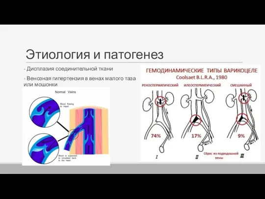 Этиология и патогенез - Дисплазия соединительной ткани - Венозная гипертензия в венах малого таза или мошонки
