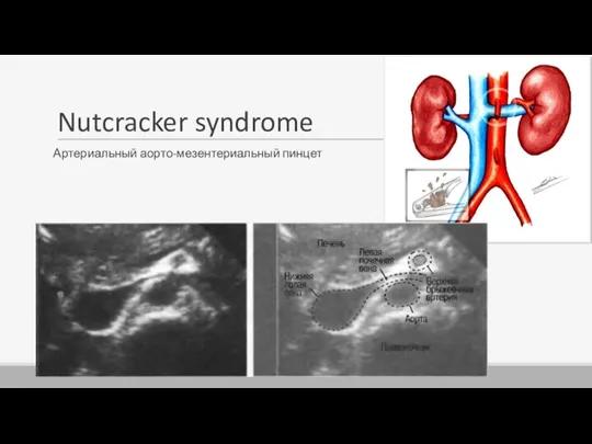 Nutcracker syndrome Артериальный аорто-мезентериальный пинцет