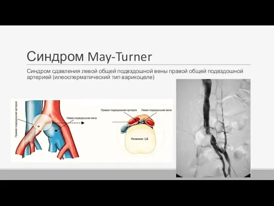 Синдром May-Turner Синдром сдавления левой общей подвздошной вены правой общей подвздошной артерией (илеосперматический тип варикоцеле)