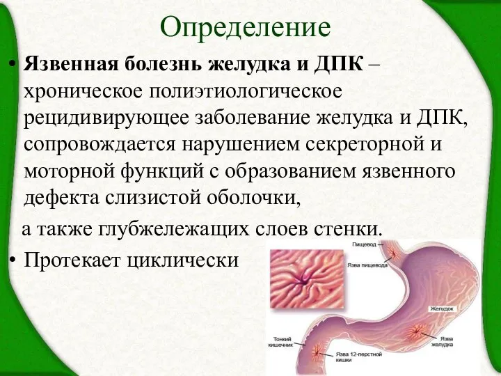 Определение Язвенная болезнь желудка и ДПК – хроническое полиэтиологическое рецидивирующее заболевание желудка