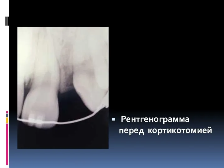 Рентгенограмма перед кортикотомией