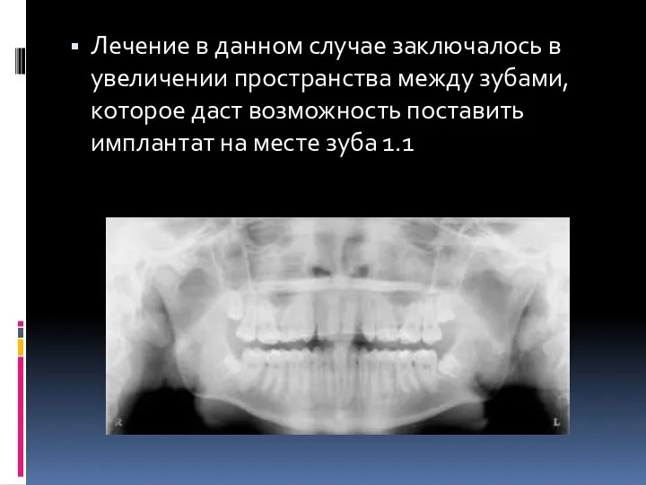 Лечение в данном случае заключалось в увеличении пространства между зубами, которое даст