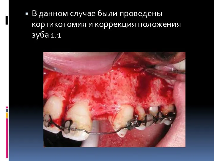 В данном случае были проведены кортикотомия и коррекция положения зуба 1.1