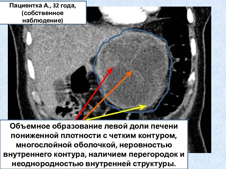 Объемное образование левой доли печени пониженной плотности с четким контуром, многослойной оболочкой,