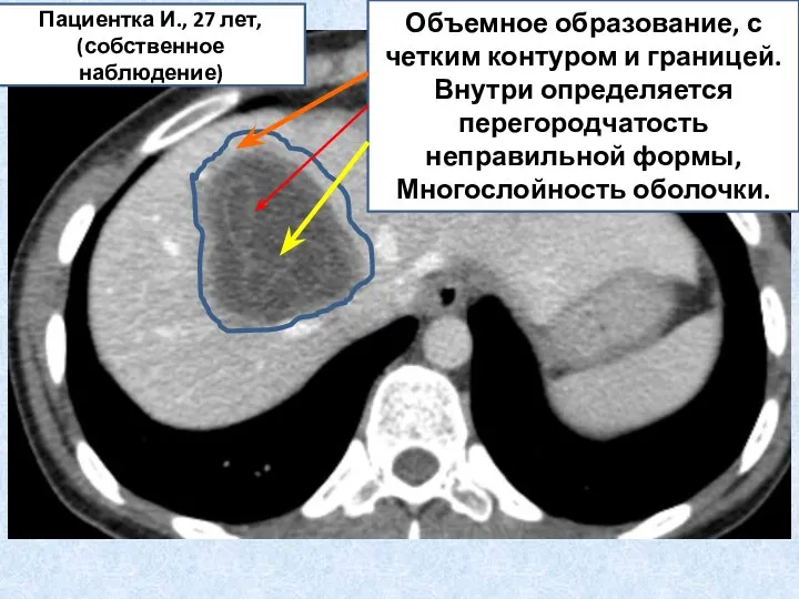 Объемное образование, с четким контуром и границей. Внутри определяется перегородчатость неправильной формы,