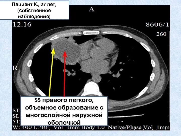 S5 правого легкого, объемное образование с многослойной наружной оболочкой Пациент К., 27 лет, (собственное наблюдение)