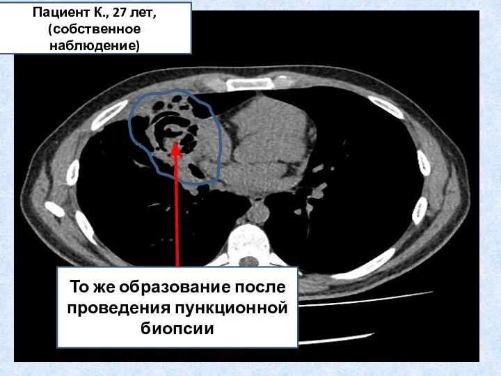 То же образование после проведения пункционной биопсии Пациент К., 27 лет, (собственное наблюдение)