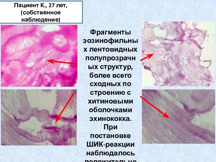 Пациент К., 27 лет, (собственное наблюдение) Фрагменты эозинофильных лентовидных полупрозрачных структур, более